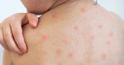 হামে আরও ৪ জনের প্রাণহানি, নতুন শনাক্ত ৬৮৫