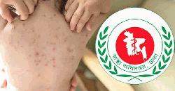 হাম ও উপসর্গ নিয়ে আরও ৬ জনের মৃত্যু